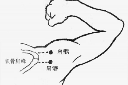 秋季高发五十肩 中医来防治