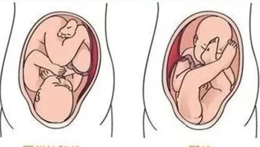 要生了胎位不正该如何