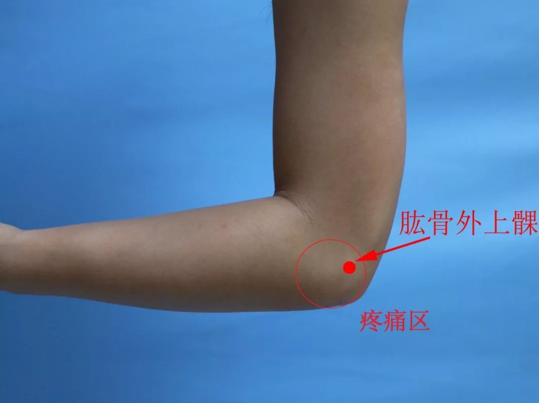 一网打尽“网球肘”,让疼痛说走就走