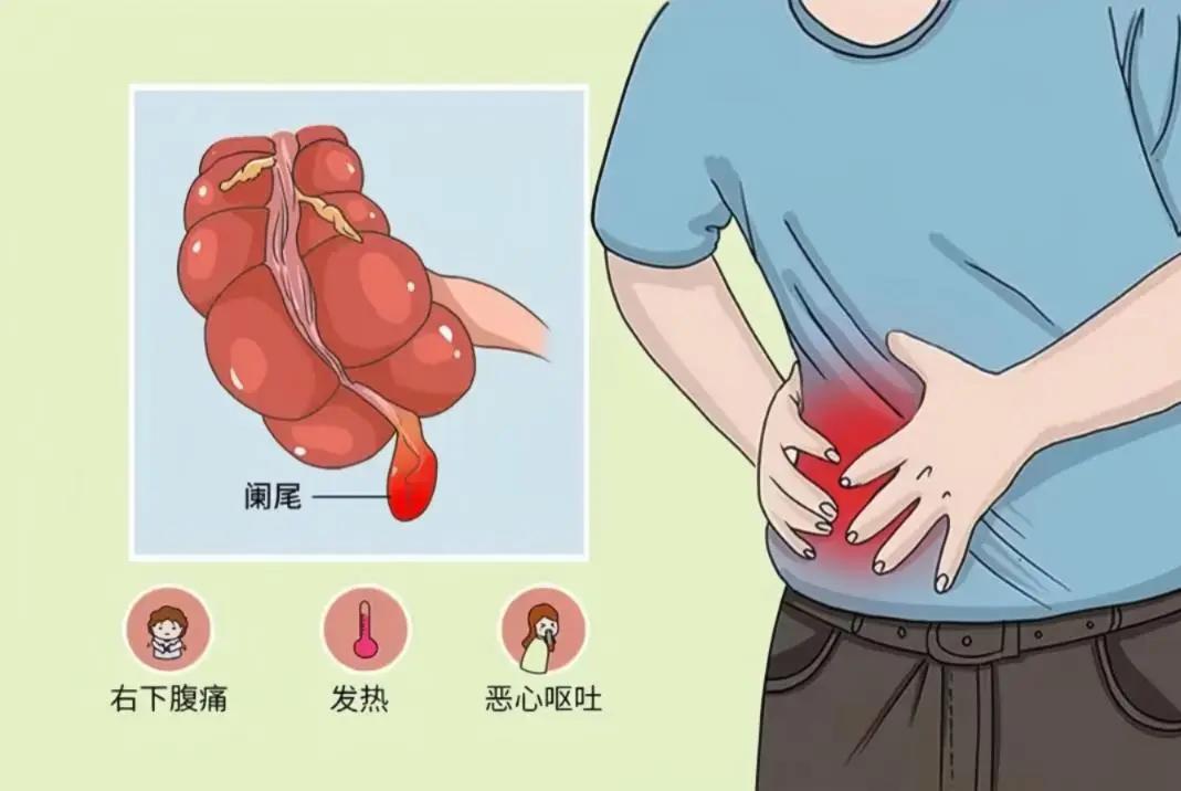 认识阑尾，远离阑尾炎之扰