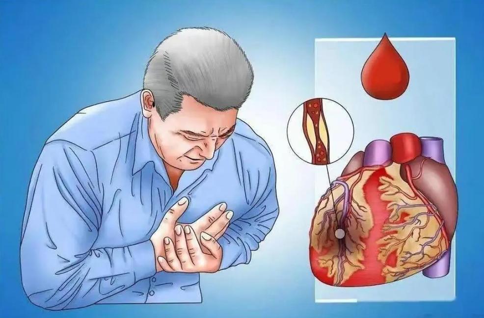 心梗后护理不可忽视