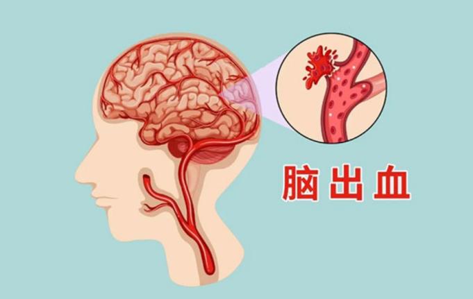小孔洞解决大问题——神经内镜技术在脑出血手术中的应用