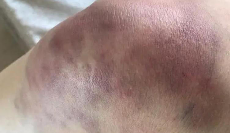 骨关节炎：常见病因及预防措施