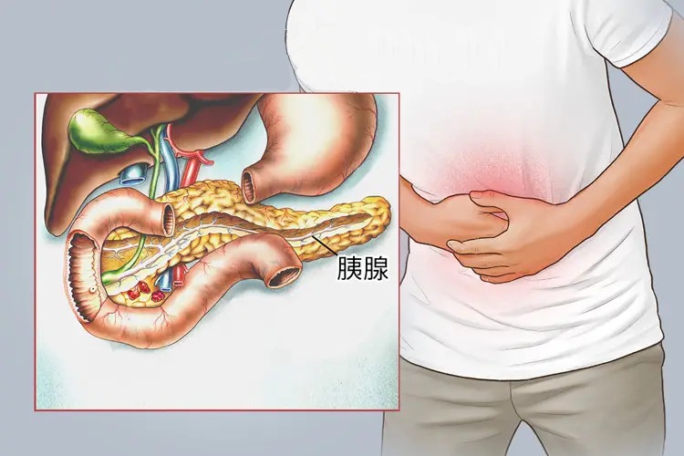 小小胰腺，拿捏