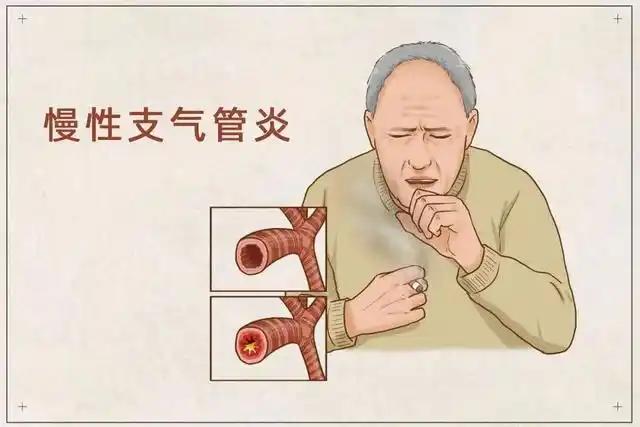 这些慢性疾病冬季易复发
