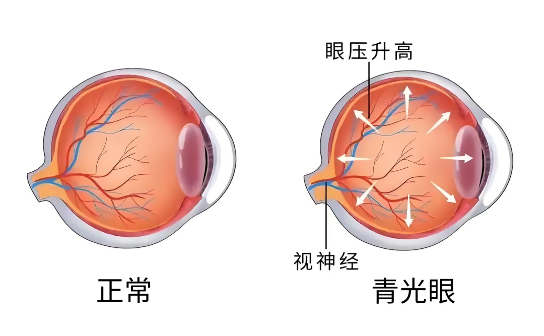 防治青光眼，守护视力