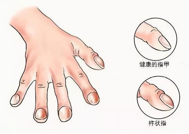 有杵状指就是肺癌吗？