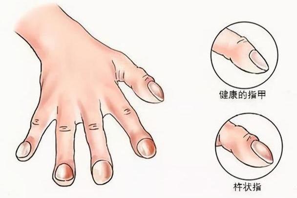 有杵状指就是肺癌吗？