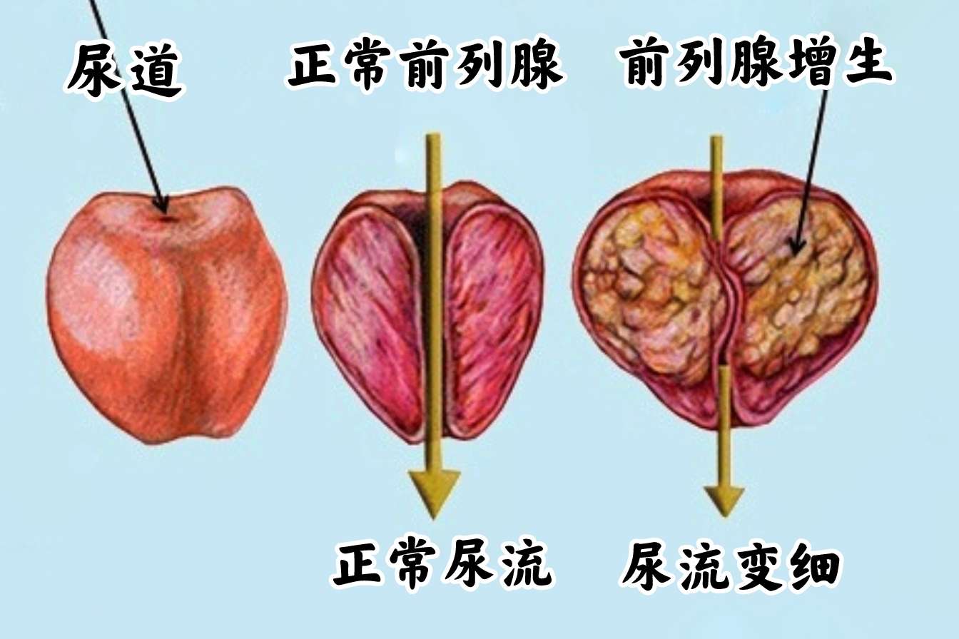 泌尿外科新知：如何预防和治疗前列腺肥大？