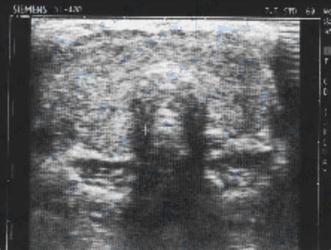 甲状腺超声：揪出微小病灶的精准猎手