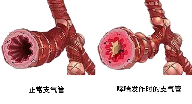 哮喘用药误区大揭秘：这些错误，你中招了吗？