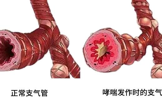 哮喘用药误区大揭秘：这些错误，你中招了吗？