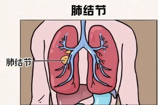肺部结节不用怕,科学认知来解答