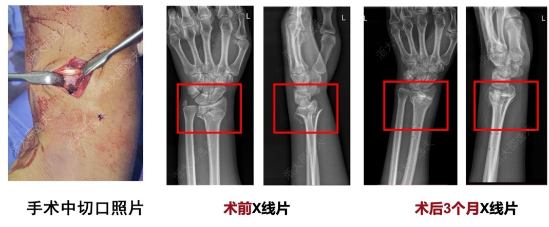 用“胶水”拯救粉碎性骨折—— “骨02”靠谱吗?