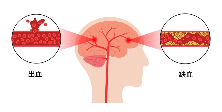 脑出血和脑梗塞不是一回事