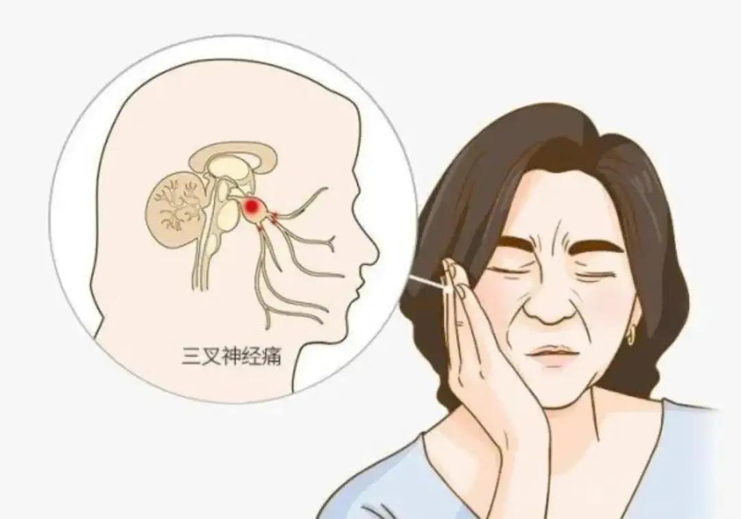 五招精准应对三叉神经痛