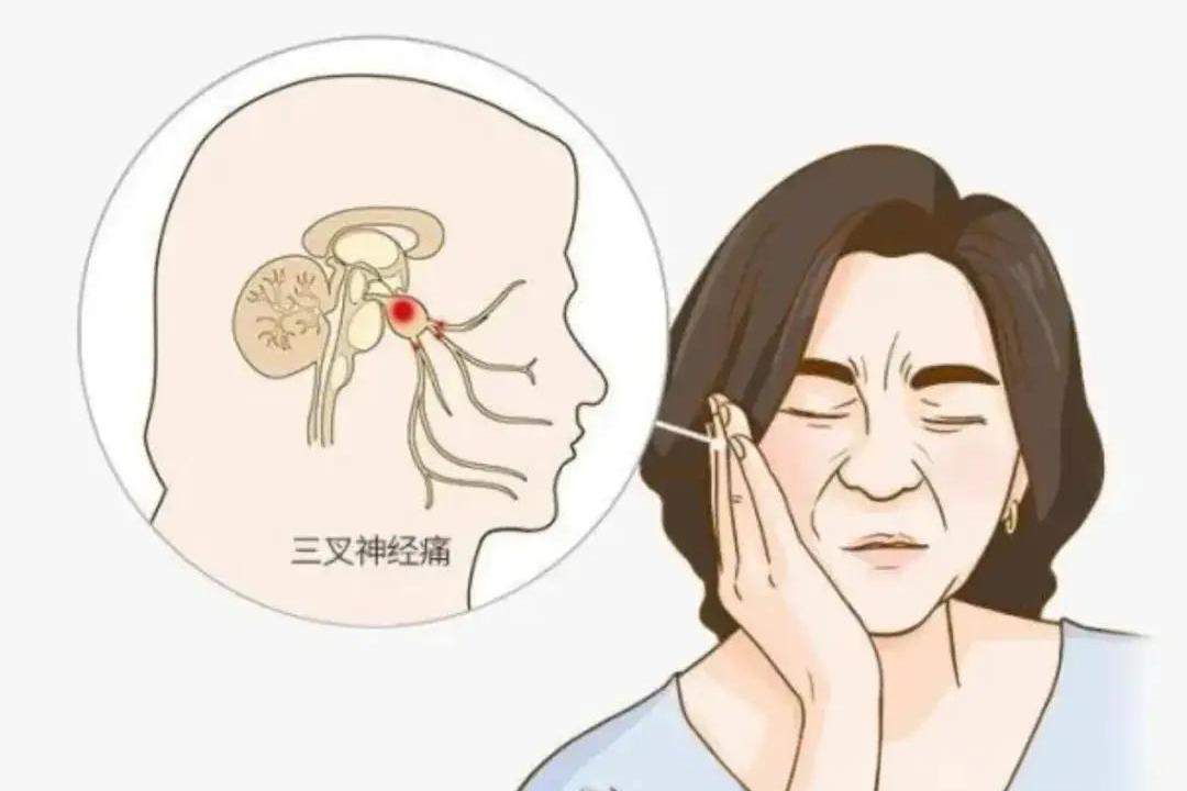 五招精准应对三叉神经痛