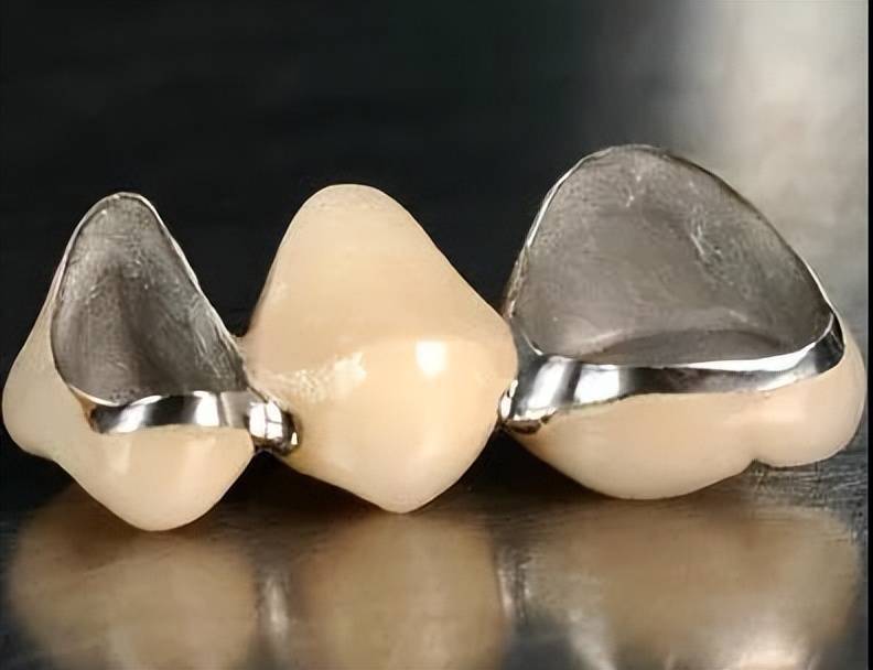 烤瓷牙和全瓷牙，谁是“颜值与耐用”的双料冠军？