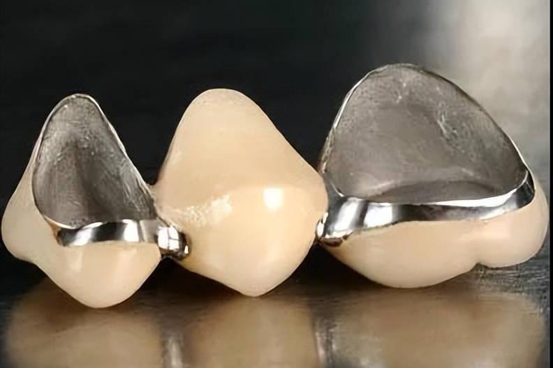 烤瓷牙和全瓷牙，谁是“颜值与耐用”的双料冠军？