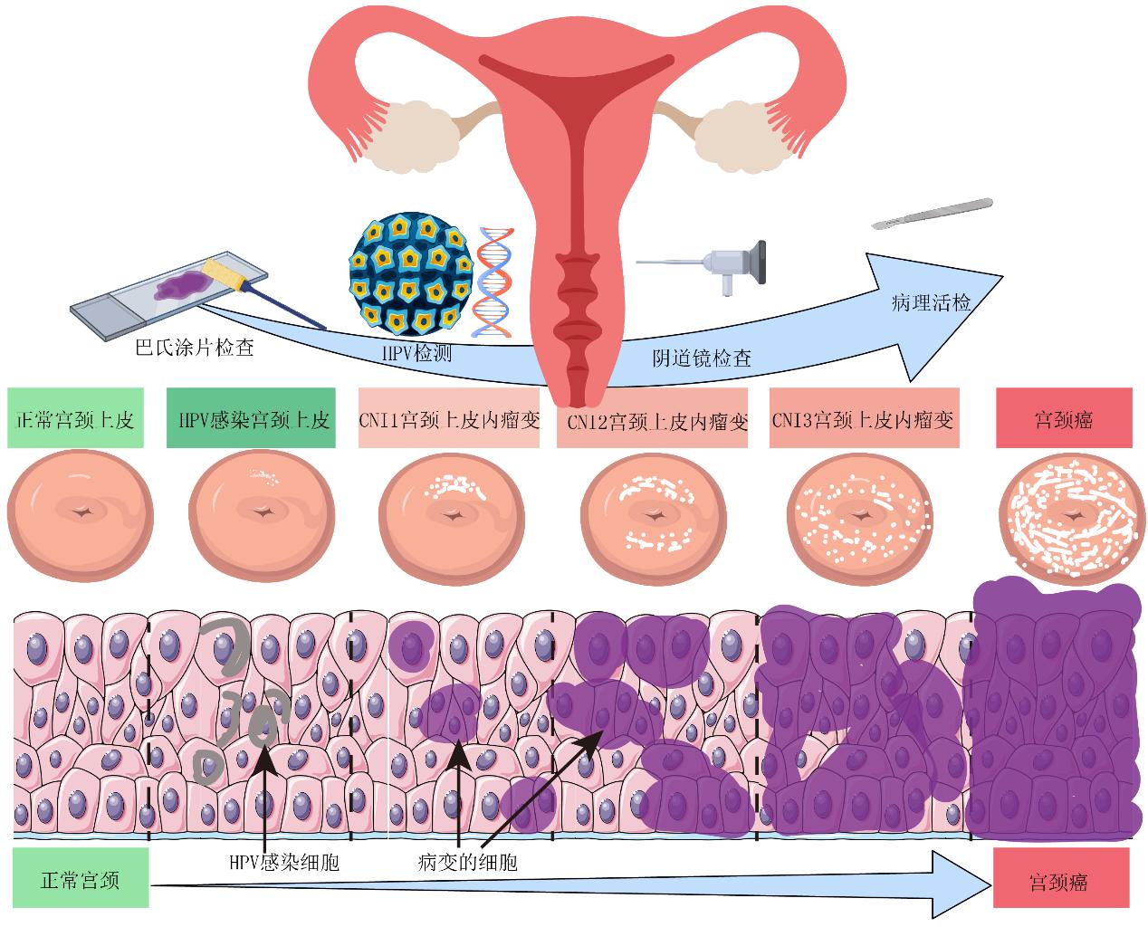 关于宫颈癌，这些知识每位女性都该了解