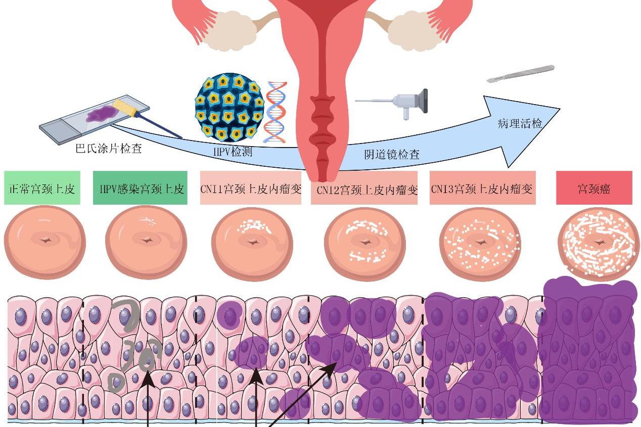 关于宫颈癌，这些知识每位女性都该了解
