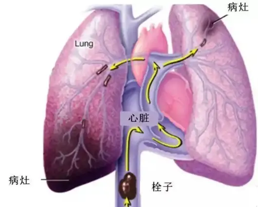 久坐不动，暗藏杀机 -警惕久坐与长途旅行后突发肺栓塞